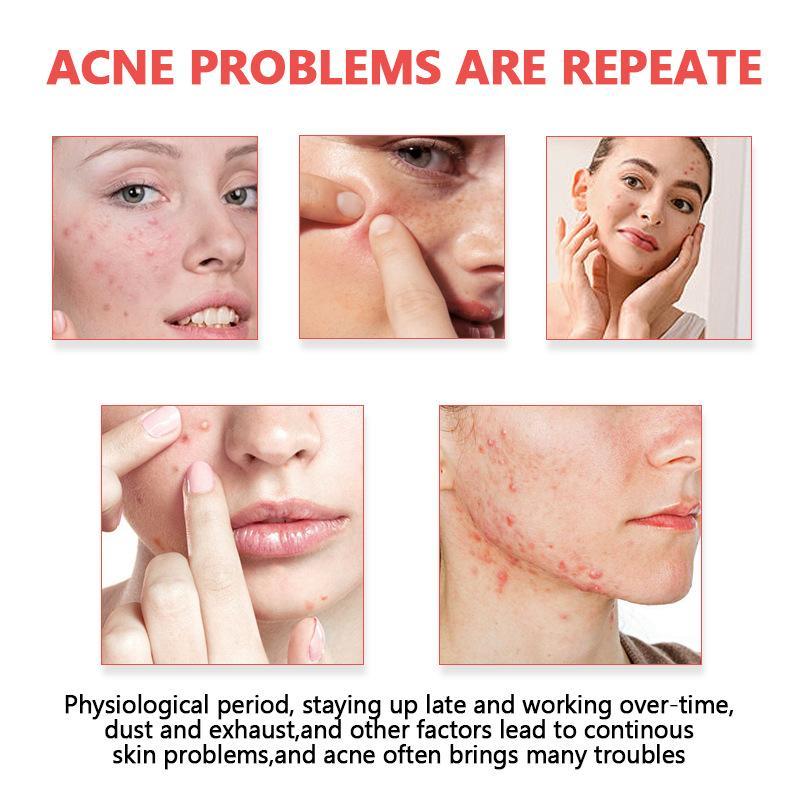 Acnepleisters Onzichtbare hydr - Skincare recensie en prijs